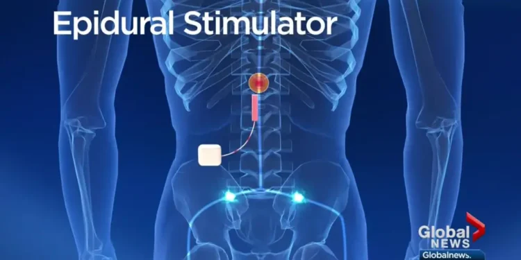 New simulation method enables prediction of promising treatments for spinal cord injury without requiring experimentation in patients. New simulation method enables prediction of promising treatments for spinal cord injury without requiring experimentation in patients.