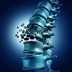 Spinal Cord Injury Treatment