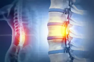 Spinal Cord Injury Treatment